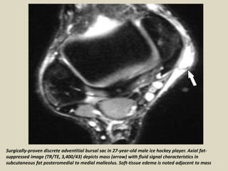 Surgically-proven discrete adventitial bursal sac in 27-year-old male ice hockey player. Axial fat-
suppressed image (TR/TE, 3,400/43) depicts mass (arrow) with fluid signal characteristics in
subcutaneous fat posteromedial to medial malleolus. Soft-tissue edema is noted adjacent to mass
 