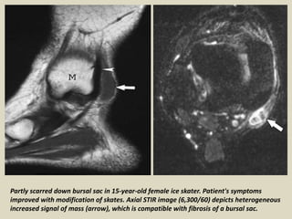 Partly scarred down bursal sac in 15-year-old female ice skater. Patient's symptoms
improved with modification of skates. Axial STIR image (6,300/60) depicts heterogeneous
increased signal of mass (arrow), which is compatible with fibrosis of a bursal sac.
 