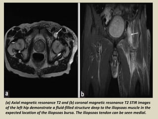 (a) Axial magnetic resonance T2 and (b) coronal magnetic resonance T2 STIR images
of the left hip demonstrate a fluid-filled structure deep to the iliopsoas muscle in the
expected location of the iliopsoas bursa. The iliopsoas tendon can be seen medial.
 