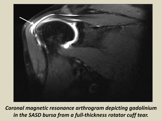 Coronal magnetic resonance arthrogram depicting gadolinium
in the SASD bursa from a full-thickness rotator cuff tear.
 