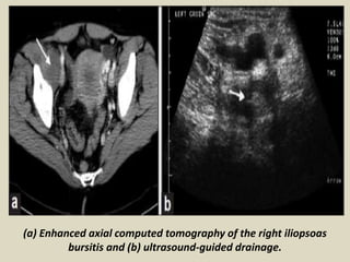 (a) Enhanced axial computed tomography of the right iliopsoas
bursitis and (b) ultrasound-guided drainage.
 