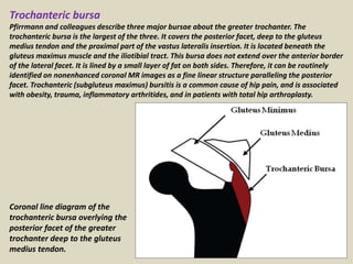 Trochanteric bursa
Pfirrmann and colleagues describe three major bursae about the greater trochanter. The
trochanteric bursa is the largest of the three. It covers the posterior facet, deep to the gluteus
medius tendon and the proximal part of the vastus lateralis insertion. It is located beneath the
gluteus maximus muscle and the iliotibial tract. This bursa does not extend over the anterior border
of the lateral facet. It is lined by a small layer of fat on both sides. Therefore, it can be routinely
identified on nonenhanced coronal MR images as a fine linear structure paralleling the posterior
facet. Trochanteric (subgluteus maximus) bursitis is a common cause of hip pain, and is associated
with obesity, trauma, inflammatory arthritides, and in patients with total hip arthroplasty.
Coronal line diagram of the
trochanteric bursa overlying the
posterior facet of the greater
trochanter deep to the gluteus
medius tendon.
 
