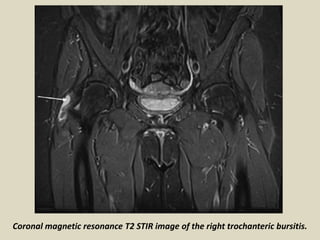 Coronal magnetic resonance T2 STIR image of the right trochanteric bursitis.
 