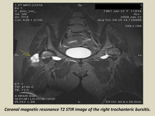 Coronal magnetic resonance T2 STIR image of the right trochanteric bursitis.
 