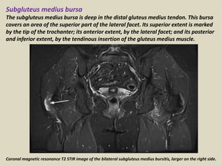 Subgluteus medius bursa
The subgluteus medius bursa is deep in the distal gluteus medius tendon. This bursa
covers an area of the superior part of the lateral facet. Its superior extent is marked
by the tip of the trochanter; its anterior extent, by the lateral facet; and its posterior
and inferior extent, by the tendinous insertion of the gluteus medius muscle.
Coronal magnetic resonance T2 STIR image of the bilateral subgluteus medius bursitis, larger on the right side.
 