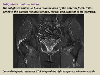 Subgluteus minimus bursa
The subgluteus minimus bursa is in the area of the anterior facet. It lies
beneath the gluteus minimus tendon, medial and superior to its insertion.
Coronal magnetic resonance STIR image of the right subgluteus minimus bursitis.
 