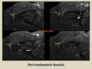 Peri trochanteric bursitis.
 
