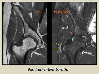 Peri trochanteric bursitis.
 