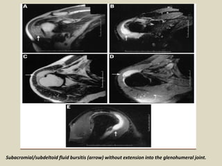 Subacromial/subdeltoid fluid bursitis (arrow) without extension into the glenohumeral joint.
 
