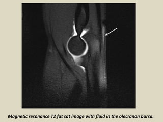 Magnetic resonance T2 fat sat image with fluid in the olecranon bursa.
 