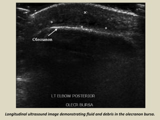 Longitudinal ultrasound image demonstrating fluid and debris in the olecranon bursa.
 
