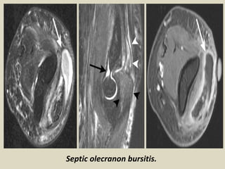 Septic olecranon bursitis.
 
