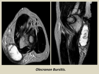 Olecranon Bursitis.
 
