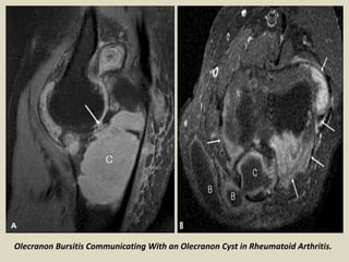 Olecranon Bursitis Communicating With an Olecranon Cyst in Rheumatoid Arthritis.
 