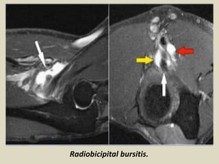 Radiobicipital bursitis.
 