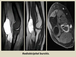 Radiobicipital bursitis.
 