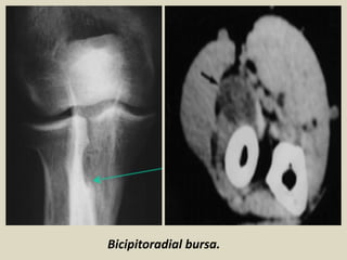 Bicipitoradial bursa.
 