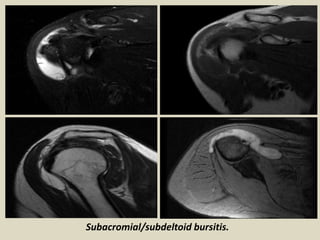 Subacromial/subdeltoid bursitis.
 