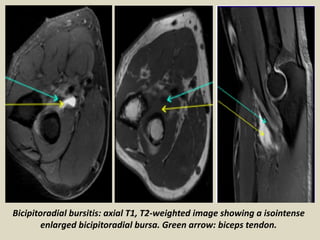 Bicipitoradial bursitis: axial T1, T2-weighted image showing a isointense
enlarged bicipitoradial bursa. Green arrow: biceps tendon.
 
