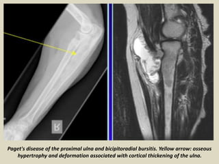 Paget's disease of the proximal ulna and bicipitoradial bursitis. Yellow arrow: osseous
hypertrophy and deformation associated with cortical thickening of the ulna.
 