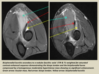 Bicipitoradial bursitis secondary to a nodular fasciitis: axial STIR & T1-weighted fat saturated
contrast-enhanced sequence demonstrating the biceps tendon and the bicipitoradial bursa
compressed by a homogeneous moderately hyperintense mass showing no significant enhancement.
Green arrow: tissular mass. Red arrow: biceps tendon. Yellow arrow: bicipitoradial bursitis
 