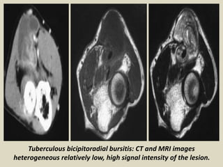 Tuberculous bicipitoradial bursitis: CT and MRI images
heterogeneous relatively low, high signal intensity of the lesion.
 