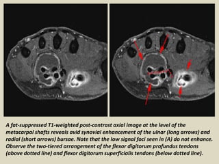 A fat-suppressed T1-weighted post-contrast axial image at the level of the
metacarpal shafts reveals avid synovial enhancement of the ulnar (long arrows) and
radial (short arrows) bursae. Note that the low signal foci seen in (A) do not enhance.
Observe the two-tiered arrangement of the flexor digitorum profundus tendons
(above dotted line) and flexor digitorum superficialis tendons (below dotted line).
 