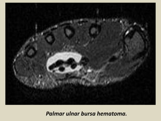 Palmar ulnar bursa hematoma.
 