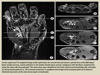 On fat-suppressed T2-weighted image of the right hand, the coronal view (A) shows a partial tear of the fifth finger
flexor tendon (arrow), a fluid collection in the tendon sheath (open arrow), contiguous with the flexor compartment
along the ulnar side (arrowheads). The axial views were obtained at the levels of the proximal phalanx (B), mid-palm
(C) and proximal palm (D-1). The contrast-enhanced T1-weighted axial image of the proximal palm (D-2) shows a
thickened synovium of the ulnar bursa (open arrowheads).
 