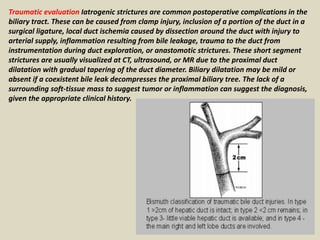 Traumatic evaluation Iatrogenic strictures are common postoperative complications in the
biliary tract. These can be caused from clamp injury, inclusion of a portion of the duct in a
surgical ligature, local duct ischemia caused by dissection around the duct with injury to
arterial supply, inflammation resulting from bile leakage, trauma to the duct from
instrumentation during duct exploration, or anastomotic strictures. These short segment
strictures are usually visualized at CT, ultrasound, or MR due to the proximal duct
dilatation with gradual tapering of the duct diameter. Biliary dilatation may be mild or
absent if a coexistent bile leak decompresses the proximal biliary tree. The lack of a
surrounding soft-tissue mass to suggest tumor or inflammation can suggest the diagnosis,
given the appropriate clinical history.
 