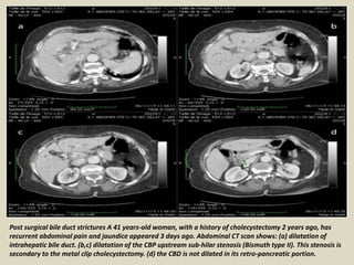 Post surgical bile duct strictures A 41 years-old woman, with a history of cholecystectomy 2 years ago, has
recurrent abdominal pain and jaundice appeared 3 days ago. Abdominal CT scan shows: (a) dilatation of
intrahepatic bile duct. (b,c) dilatation of the CBP upstream sub-hilar stenosis (Bismuth type II). This stenosis is
secondary to the metal clip cholecystectomy. (d) the CBD is not dilated in its retro-pancreatic portion.
 