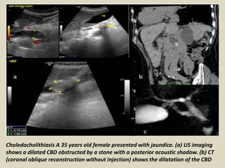 Choledocholithiasis A 35 years old female presented with jaundice. (a) US imaging
shows a dilated CBD obstructed by a stone with a posterior acoustic shadow. (b) CT
(coronal oblique reconstruction without injection) shows the dilatation of the CBD
 