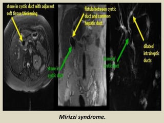 Mirizzi syndrome.
 