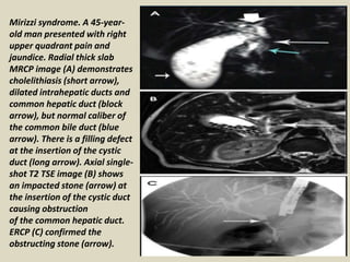 Mirizzi syndrome. A 45-year-
old man presented with right
upper quadrant pain and
jaundice. Radial thick slab
MRCP image (A) demonstrates
cholelithiasis (short arrow),
dilated intrahepatic ducts and
common hepatic duct (block
arrow), but normal caliber of
the common bile duct (blue
arrow). There is a filling defect
at the insertion of the cystic
duct (long arrow). Axial single-
shot T2 TSE image (B) shows
an impacted stone (arrow) at
the insertion of the cystic duct
causing obstruction
of the common hepatic duct.
ERCP (C) confirmed the
obstructing stone (arrow).
 
