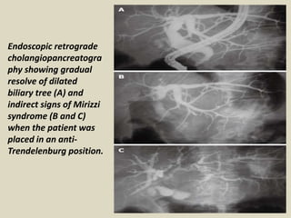 Endoscopic retrograde
cholangiopancreatogra
phy showing gradual
resolve of dilated
biliary tree (A) and
indirect signs of Mirizzi
syndrome (B and C)
when the patient was
placed in an anti-
Trendelenburg position.
 