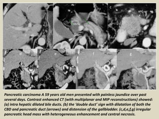 Pancreatic carcinoma A 59 years old men presented with painless jaundice over past
several days. Contrast enhanced CT (with multiplanar and MIP reconstructions) showed:
(a) intra hepatic dilated bile ducts. (b) the ‘double duct’ sign with dilatation of both the
CBD and pancreatic duct (arrows) and distension of the gallbladder. (c,d,e,f,g) irregular
pancreatic head mass with heterogeneous enhancement and central necrosis.
 