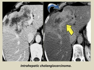 Intrahepatic cholangiocarcinoma.
 