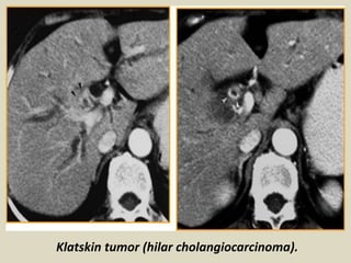 Klatskin tumor (hilar cholangiocarcinoma).
 