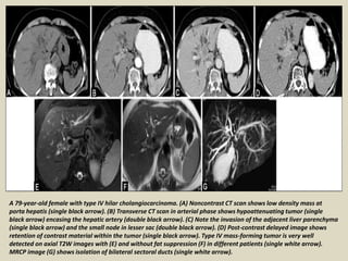 A 79-year-old female with type IV hilar cholangiocarcinoma. (A) Noncontrast CT scan shows low density mass at
porta hepatis (single black arrow). (B) Transverse CT scan in arterial phase shows hypoattenuating tumor (single
black arrow) encasing the hepatic artery (double black arrow). (C) Note the invasion of the adjacent liver parenchyma
(single black arrow) and the small node in lesser sac (double black arrow). (D) Post-contrast delayed image shows
retention of contrast material within the tumor (single black arrow). Type IV mass-forming tumor is very well
detected on axial T2W images with (E) and without fat suppression (F) in different patients (single white arrow).
MRCP image (G) shows isolation of bilateral sectoral ducts (single white arrow).
 