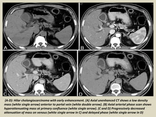 (A-D): Hilar cholangiocarcinoma with early enhancement. (A) Axial unenhanced CT shows a low density
mass (white single arrow) anterior to portal vein (white double arrow). (B) Axial arterial phase scan shows
hyperattenuating mass at primary confluence (white single arrow). (C and D) Progressively decreased
attenuation of mass on venous (white single arrow in C) and delayed phase (white single arrow in D)
 
