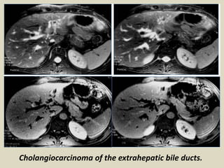 Cholangiocarcinoma of the extrahepatic bile ducts.
 