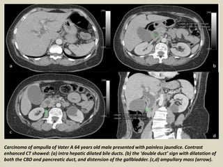 Carcinoma of ampulla of Vater A 64 years old male presented with painless jaundice. Contrast
enhanced CT showed: (a) intra hepatic dilated bile ducts. (b) the ‘double duct’ sign with dilatation of
both the CBD and pancreatic duct, and distension of the gallbladder. (c,d) ampullary mass (arrow).
 