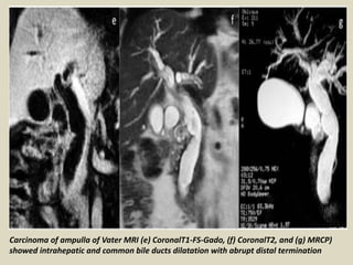 Carcinoma of ampulla of Vater MRI (e) CoronalT1-FS-Gado, (f) CoronalT2, and (g) MRCP)
showed intrahepatic and common bile ducts dilatation with abrupt distal termination
 