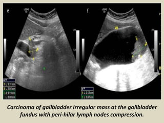 Carcinoma of gallbladder Irregular mass at the gallbladder
fundus with peri-hilar lymph nodes compression.
 