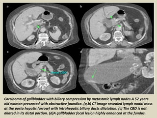 Carcinoma of gallbladder with biliary compression by metastatic lymph nodes A 52 years
old woman presented with obstructive jaundice. (a,b) CT image revealed lymph nodal mass
at the porta hepatis (arrow) with intrahepatic biliary ducts dilatation. (c) The CBD is not
dilated in its distal portion. (d)A gallbladder focal lesion highly enhanced at the fundus.
 