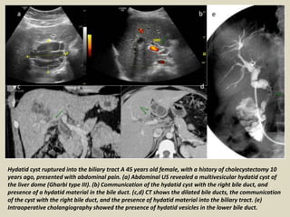 Hydatid cyst ruptured into the biliary tract A 45 years old female, with a history of cholecystectomy 10
years ago, presented with abdominal pain. (a) Abdominal US revealed a multivesicular hydatid cyst of
the liver dome (Gharbi type III). (b) Communication of the hydatid cyst with the right bile duct, and
presence of a hydatid material in the bile duct. (c,d) CT shows the dilated bile ducts, the communication
of the cyst with the right bile duct, and the presence of hydatid material into the biliary tract. (e)
Intraoperative cholangiography showed the presence of hydatid vesicles in the lower bile duct.
 