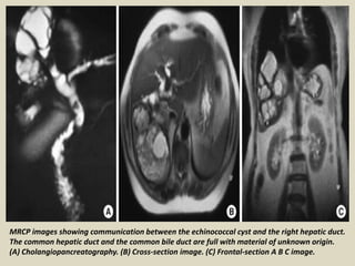 MRCP images showing communication between the echinococcal cyst and the right hepatic duct.
The common hepatic duct and the common bile duct are full with material of unknown origin.
(A) Cholangiopancreatography. (B) Cross-section image. (C) Frontal-section A B C image.
 