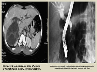 Endoscopic retrograde cholangiopancreatography demonstrating
hydatid material within the lower common bile duct.
Computed tomographic scan showing
a hydatid cyst biliary communication.
 