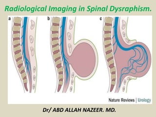 Radiological Imaging in Spinal Dysraphism.
Dr/ ABD ALLAH NAZEER. MD.
 