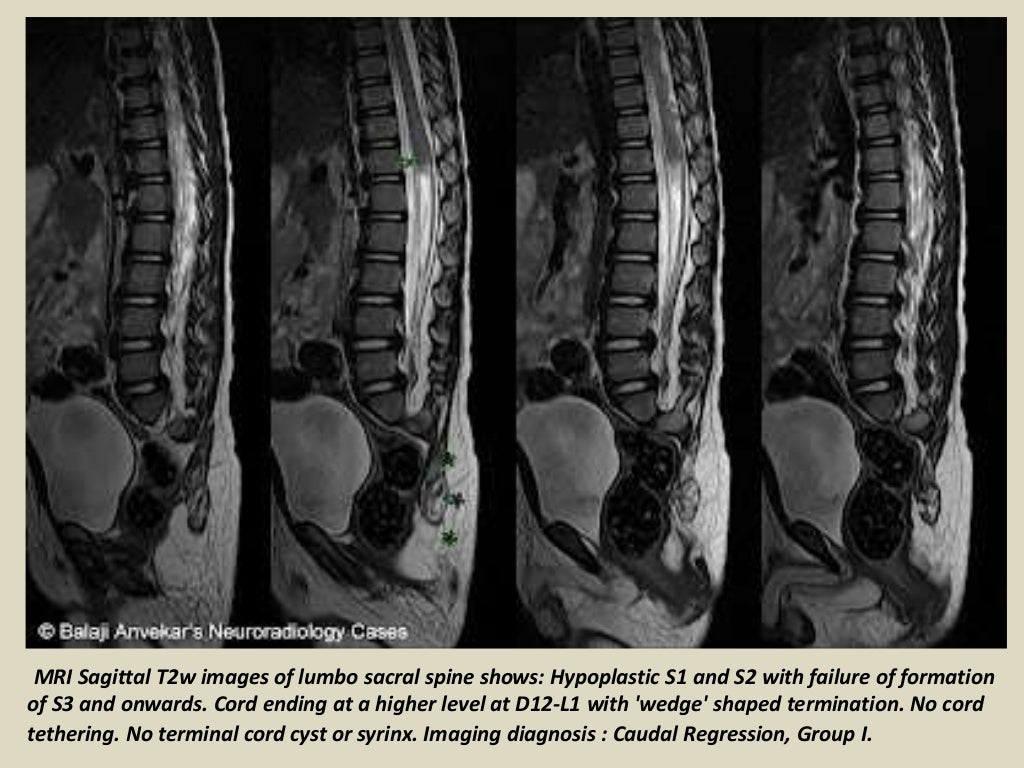 Presentation1.pptx, radiological imaging of spinal dysraphism.